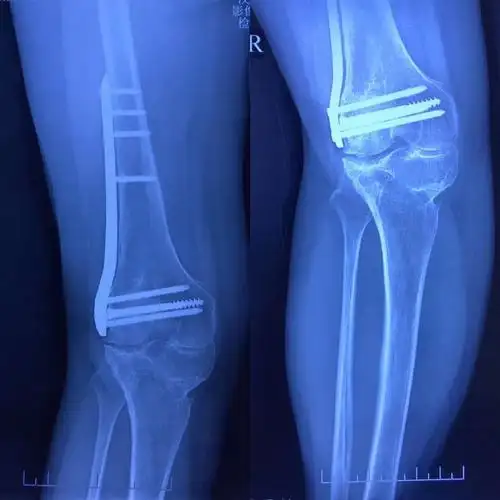 援陕记实:一例右膝创伤性关节炎伴膝外翻的手术治疗探讨