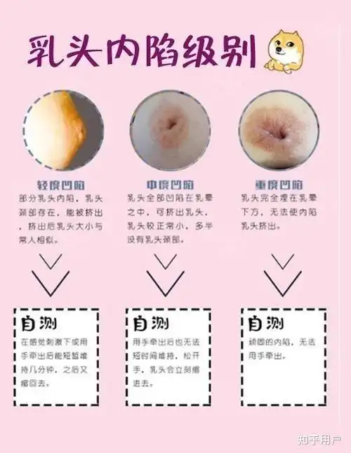 21岁女生没有乳头,不是乳头内陷,不是乳头短平,就像小女生那种刚发育