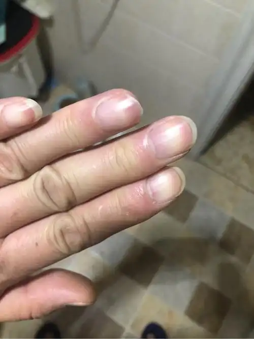 结疗9个多月,今天早晨发现平时正常的指甲变紫