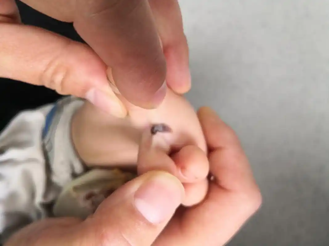 儿童脚趾缝的色素痣症状#手术##色素痣