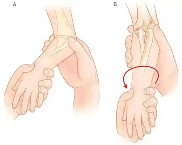 恼人的桡骨小头半脱位您了解吗