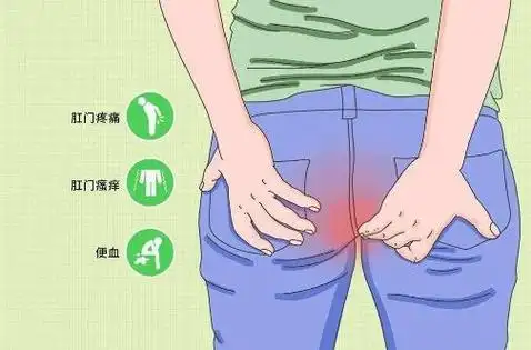 怎么判断自己得了痔疮