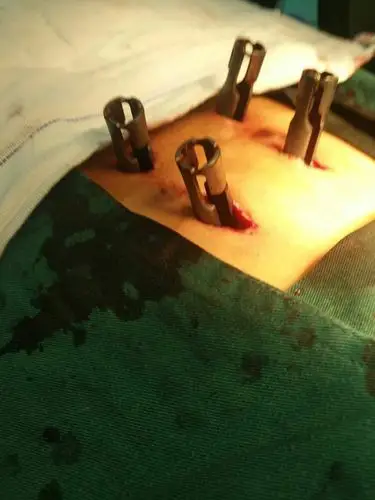 微创技术哪家强,孟州中医院骨伤科帮你忙!