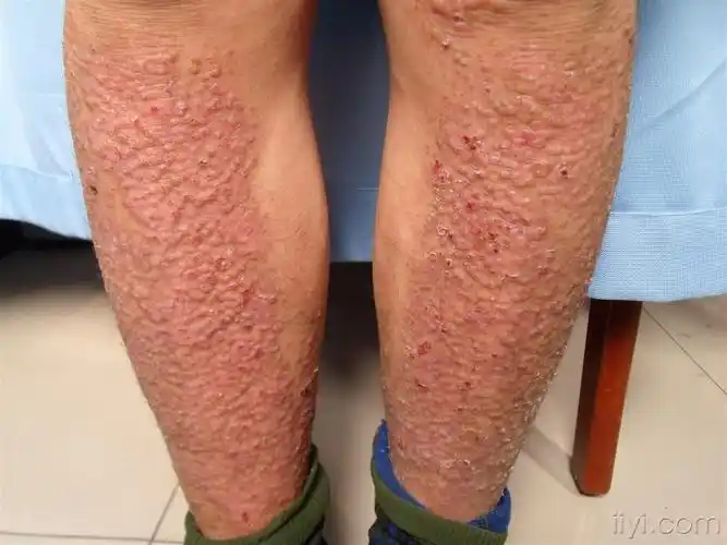 皮肤淀粉样变门诊图片