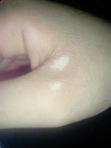 我手上会有这种白斑,怎么了的,下面有图