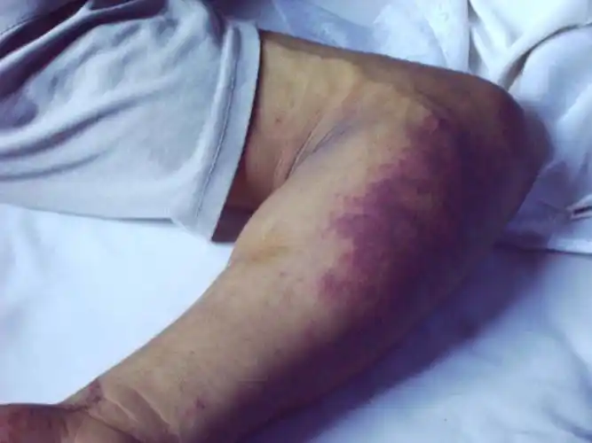 人-猪链球菌病皮肤瘀斑表现的图片