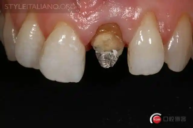 干货!前牙金属桩核处理案例