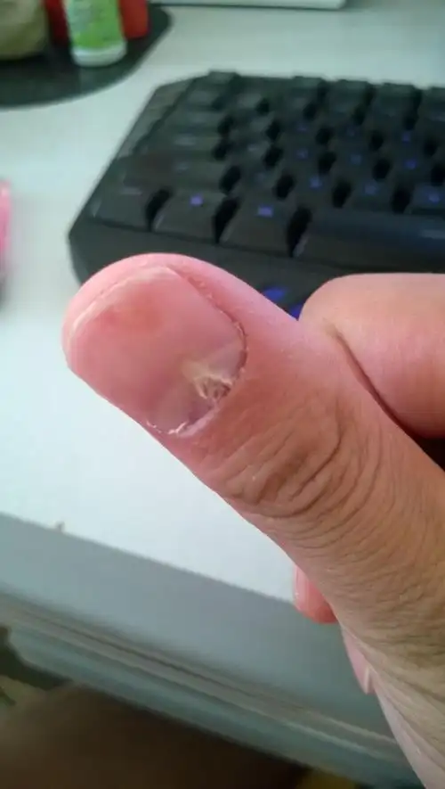 这段时间手指甲不知道怎么回事,好像肉和指甲要脱离一样,是不是灰指甲
