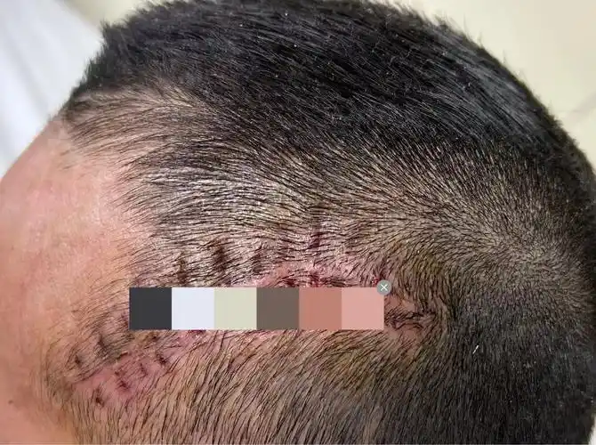 头皮皮脂腺痣手术一个月了