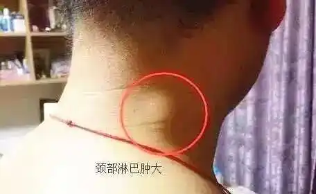 人体有三处淋巴决定生死!现在知道还不晚,只要按一按就能改善!