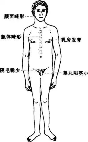 先天性睾丸发育不全综合征