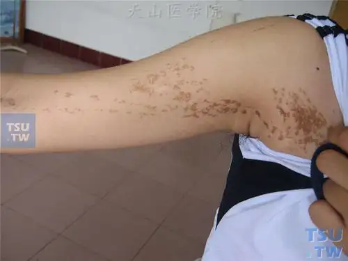 良性肿瘤:表皮痣(疣状痣)症状表现