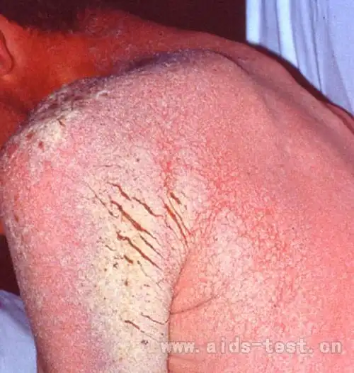 艾滋病症状 艾滋病窗口期皮疹症状与图片    大面积的艾滋病初期症状