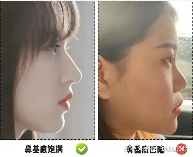 67鼻基底凹陷凸嘴法令纹侧面月牙脸的元凶