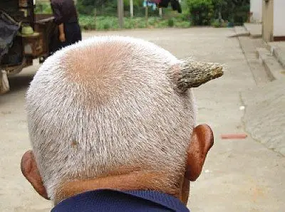 八旬老翁头上长"角"