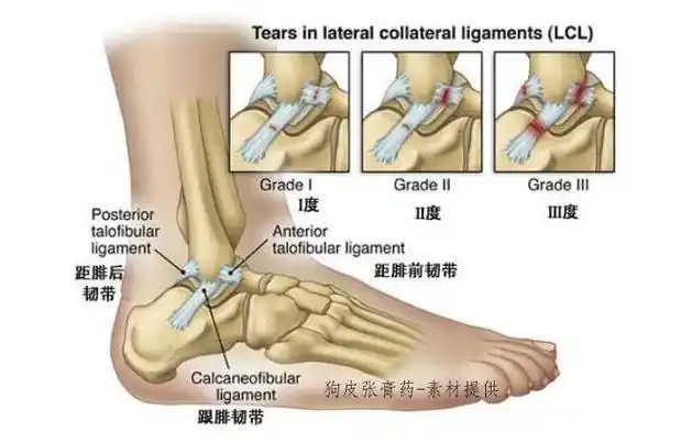 踝关节韧带损伤能用狗皮张膏药吗-产品问答-膏药铺|膏药招商加盟|狗皮
