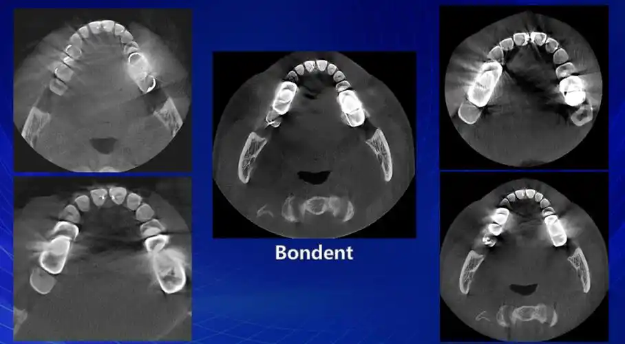 伯爵cbct影像篇⑩新春巨献伯爵口腔ct