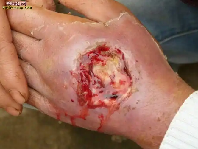 广西横县雷村蛇场治疗毒蛇咬伤案例