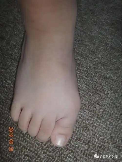 小朋友也会得大脚骨拇外翻吗