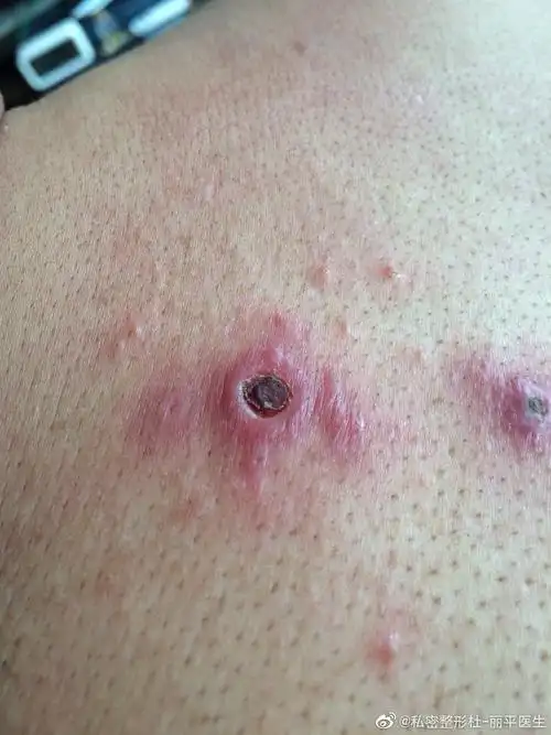 了解完毛囊炎后,我们再来看看什么是阴毛囊炎?