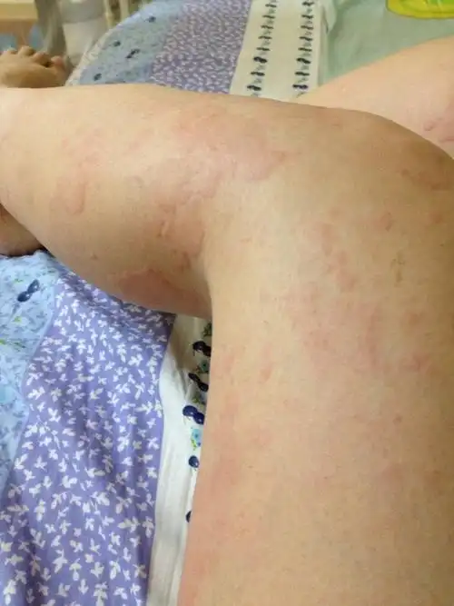 孕妇,孕11周,昨日中午开始,头,背,腿部皮肤出现红包,很痒.