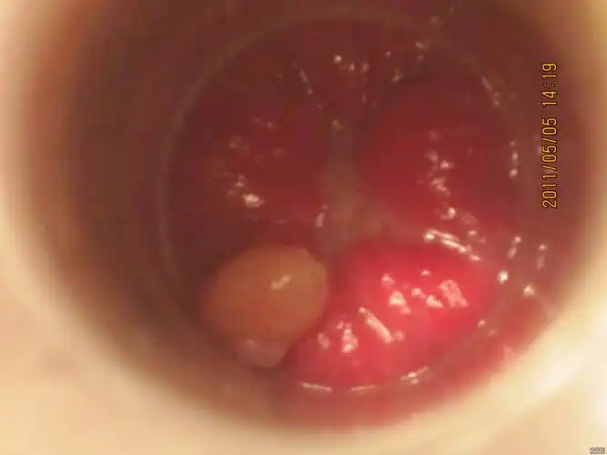 肛裂内痔肛瘤术前术后逐渐愈合欣赏