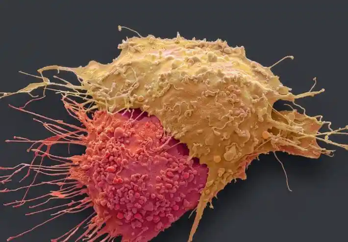 这2年经常下身会出血,她一直以为是月经没有在意,谁知道这是宫颈病变