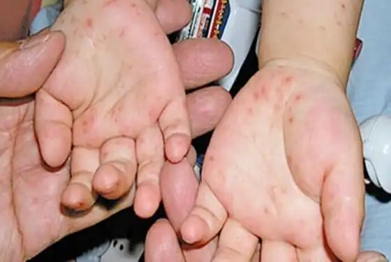 从小儿手足口病图片 看初期症状的表现