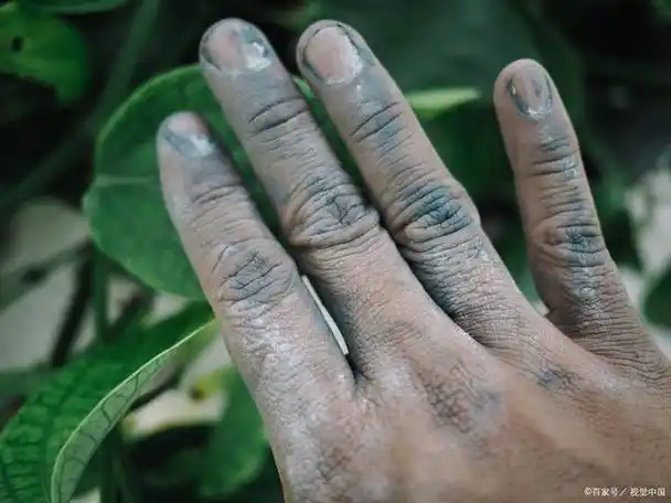 手指发黑怎么回事