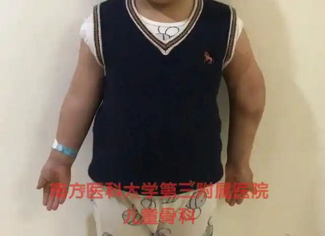 肘内翻不是小问题家长务必重视