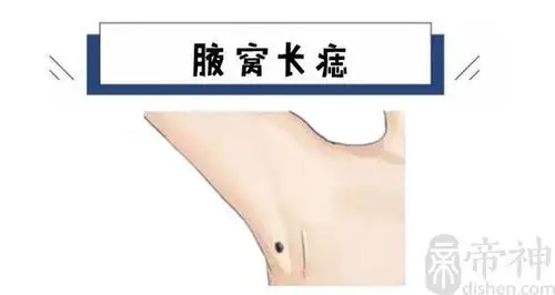 男孩腋下有痣代表什么 各时段腋下长痣有何含义