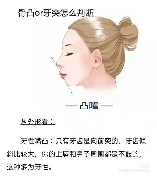 没有牙片如何简单的自测是骨性还是牙性嘴凸?