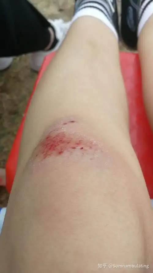 记我的擦伤… - 知乎