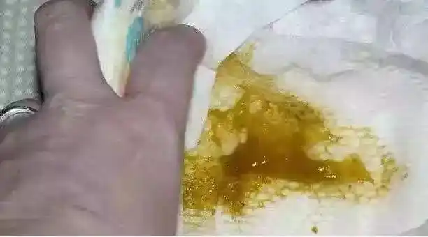 真正需要担心的是这几种便便:带血液的大便左右滑动查看更多不管是哪