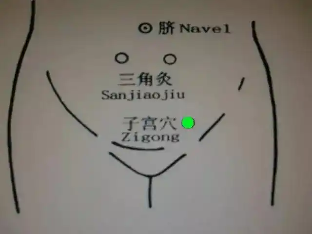 子宫肌瘤,月经不调,宫寒,艾灸这几个穴位消失了!