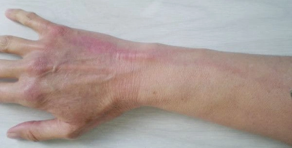 化疗为什么要留深静脉管