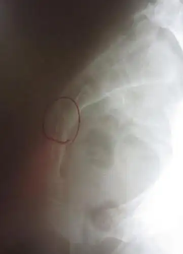 [脊柱精讲]令人坐立不安的尾椎骨疼痛到底该怎么治