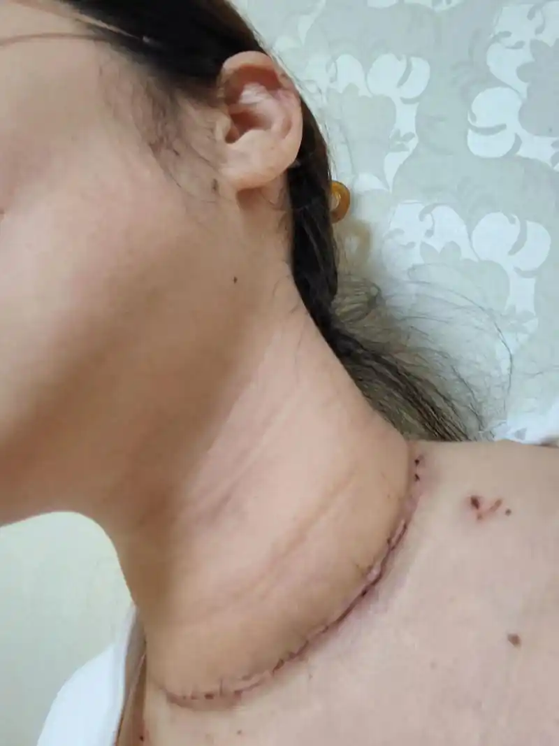 我的甲状腺癌治愈过程