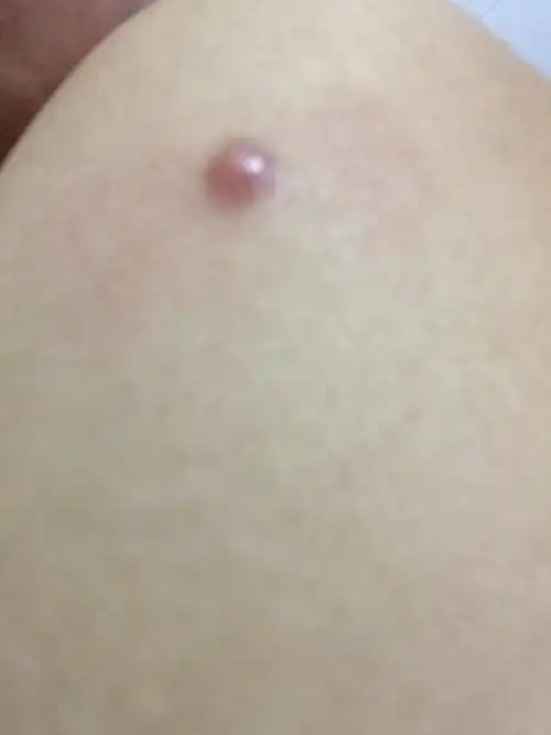 肩膀上长了一颗红肉豆!