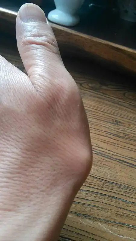 大拇指下方突出一关节以前没有上午才发现
