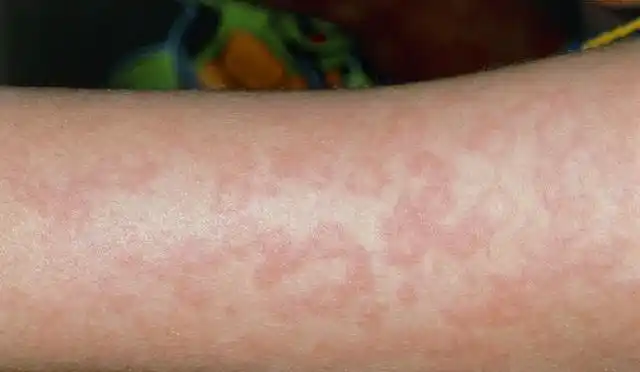 丹毒反复发作常常导致淋巴管网纤维化临床上易治愈但常有复发