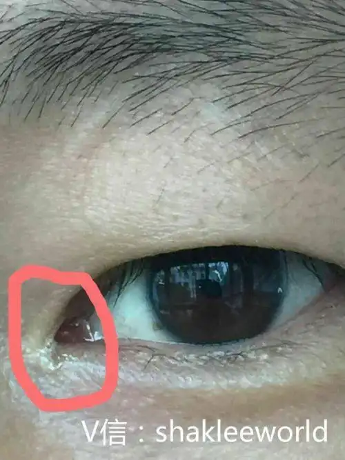 内眼角有白色分泌物是怎么回事