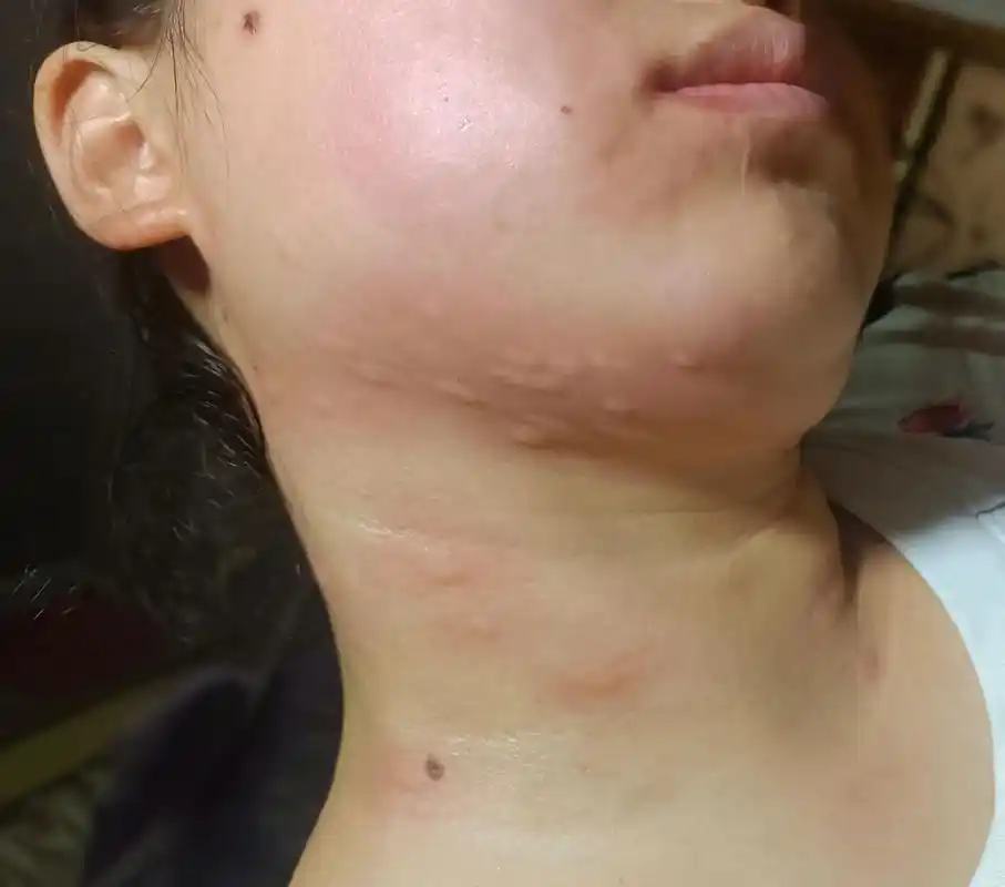 求救过敏性荨麻疹,离上次相隔12天,这次比较惨,脸都肿起来了 - 抖音