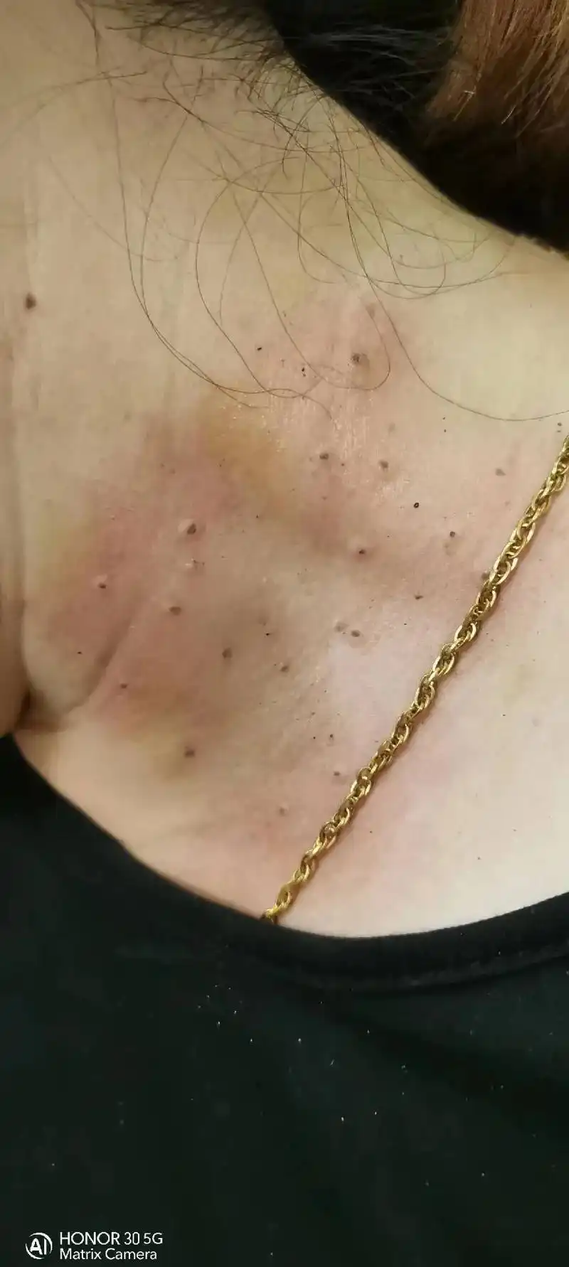 去除丝状疣#专业的事交给专业的人 #解决任何皮肤问题  - 抖音