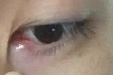 眼睛泪腺旁边肿了,眨眼有点痛