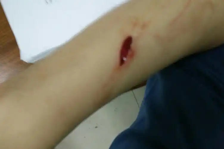 就裂开这么大的伤口,并不是很深,这也需要么?