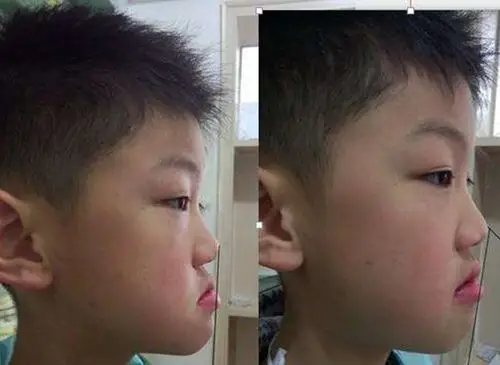 小孩地包天牵引器