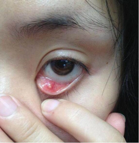 炎症早期可以局部点用抗生素眼药水加抗生素眼膏抗炎,联合局部湿热敷