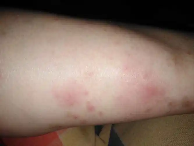 求助妈妈小腿上起了大片的红块压着发硬按压有痛感