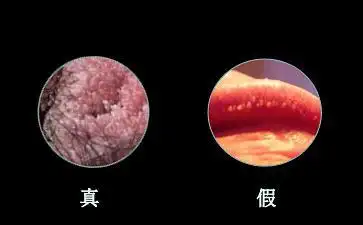 肛周尖锐湿疣怎么治疗,肛门尖锐湿症状图图片